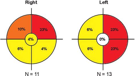 Bland breast tissue is embryologically derived and anatomically matures as a modified sweat gland. Tumor location based on laterality and breast quadrant ...