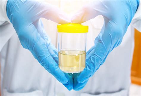 Which Method Of Urine Collection Is Best For Urinalysis