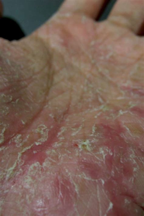 What Is Dyshidrotic Eczema How To Identify And Treat