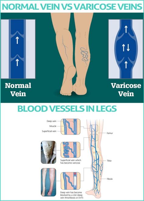 How Do You Get Varicose Veins Symptoms And Laser Treatment