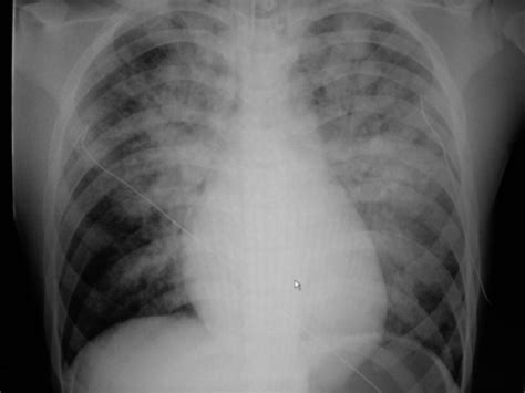 Chest X Ray Showed Bilateral Acute Pulmonary Edema Open I