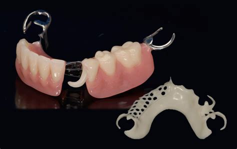 Dental Labs For Dentures In Arizona Conventional Full And Partial