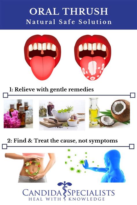 Oral Thrush Natural Safe Remedies Home Remedies For Thrush Oral