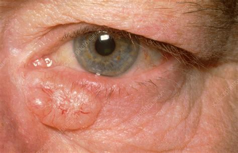 Basal Cell Carcinoma Stock Image C0365618 Science Photo Library