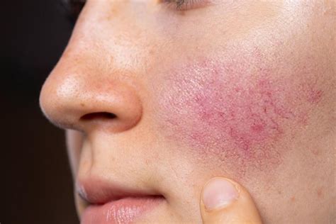 Help For Your Rosacea Specialists In Dermatology