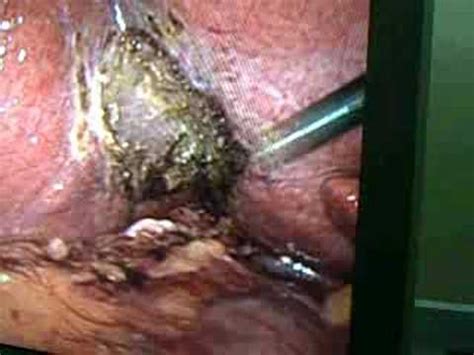 Having small amounts of fat in your liver is normal, but too can you image that? Fatty Liver - YouTube