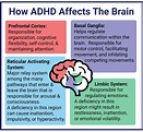 ADHD: Signs, Symptoms, and Causes