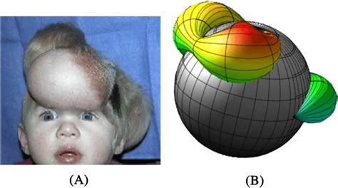 A Tissue Expansion In Pediatric Forehead Reconstruction It Shows