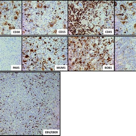 Panel Of Immunohistochemical Markers Confirming The Coexpression Of