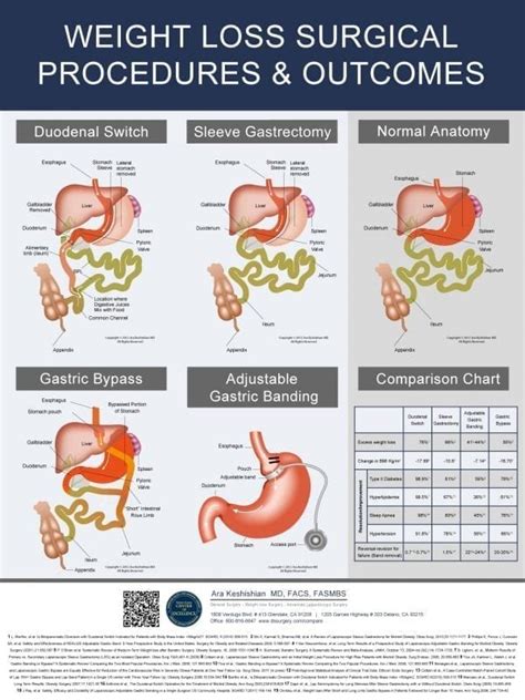 Weight Loss Surgery Dssurgery