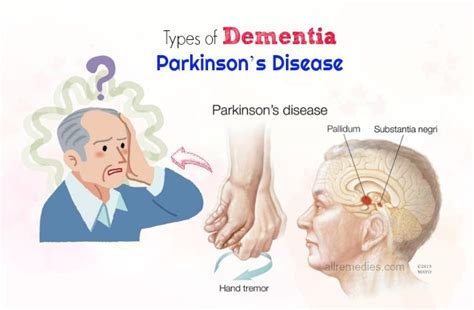 List Of 17 Common Types Of Dementia And Early Symptoms 2022