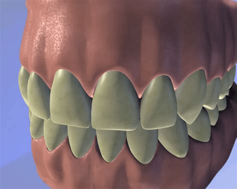 Teeth Whitening Stonehill Dental Hamilton Dentist