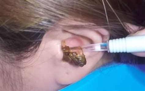 Ear Wax Removal Videos Are The New Pimple Popping Videos—check ‘em Out