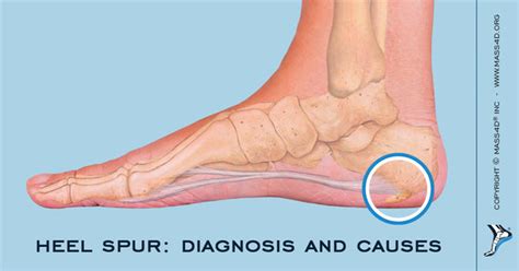 Causes And Symptoms Of Heel Spur Mass4d® Insoles Mass4d® Foot Orthotics