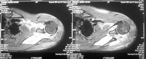 Figure 1 From Arthroscopic Decompression Of Paralabral Cyst Around