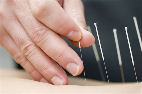 Acupuncture Is Becoming Mainstream Medical Treatment