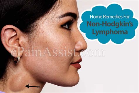 Home Remedies For Non Hodgkins Lymphoma