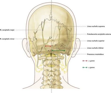 Figure 1 Anatomical Landmarks Of The Nervus Occipitalis Majorand