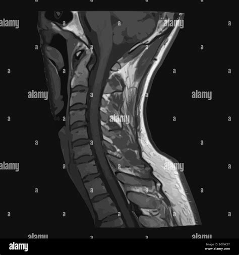 Sagittal Mri Of Cervical Spine Download Scientific Di Vrogue Co