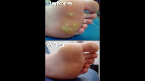 Wart Removal Treatment Before And After Youtube