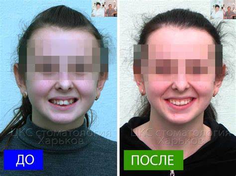 Диета при удаление зубов мудрости Стоит ли удалять зубы при дистальном прикусе? Стоит ли удалять зубы при дистальном прикусе? Диета при удаление зубов мудрости