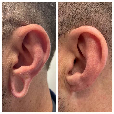 Earlobe Plastic Surgery Before And After Earlobe Repair Before And