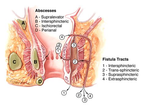 Clínica de Cirugía Gastrointestinal Fístulas anales