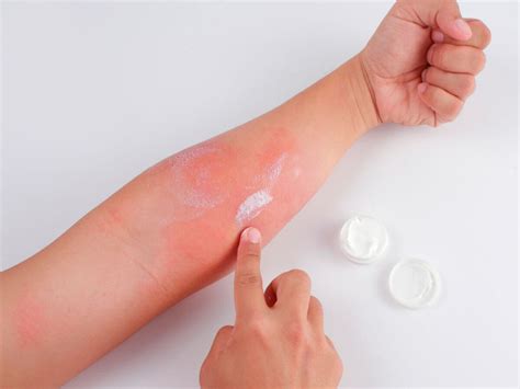 Los Tipos De Dermatitis Y Sus Caracter Sticas