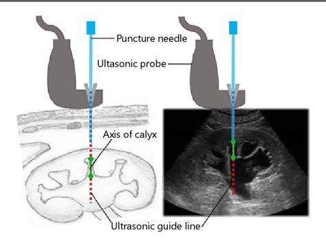 Figure 1 From The Outcomes Of Minimally Invasive Percutaneous