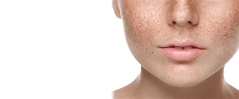 Freckles And Brown Spots Bondi Junction Cosmetic Clinic