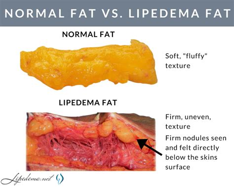 Learn About The Lipedema Or Lipomatosis Nodules