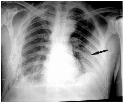 Preoperative Chest X Ray Showing A Right Sided Pleural Effusion And An
