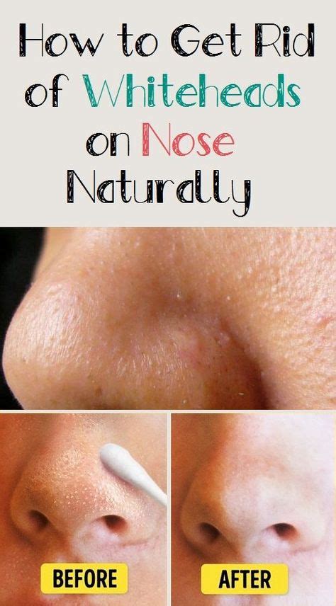 How To Get Rid Of Whiteheads On Nose Naturally Whiteheads Best