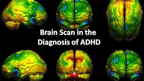 Brain Scan In The Diagnosis Of Adhd Youtube