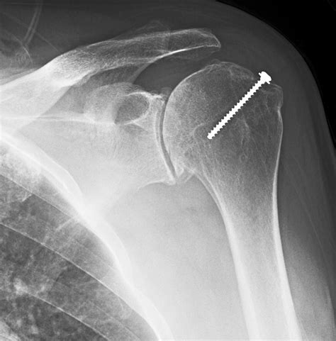 Shoulder Arthritis Rotator Cuff Tears Causes Of Shoulder Pain