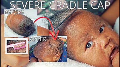 How To Get Rid Of Eczema Cradle Cap On Newborn Scalp Fast Bubs