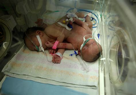 Conjoined Twins From Gaza Undergo Surgery In Saudi Arabia Arab