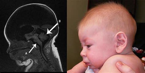 Hydranencephaly Causes Signs Symptoms Diagnosis And Treatment