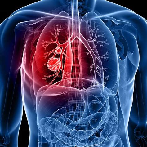 About 70% of people with sclc will have cancer that has already spread at the time they are diagnosed. Lung Cancer | Johns Hopkins Medicine Health Library