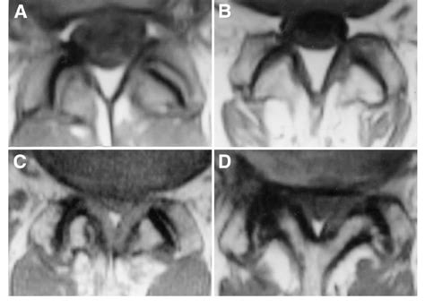 A D Four Grades Of Facet Joint Osteoarthritis On Mri Tr 570 Mste