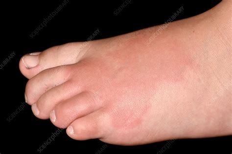 Wasp Sting Reaction Stock Image C037 0864 Science Photo Library