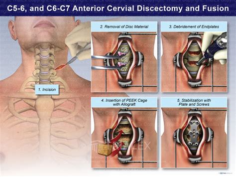 C5 6 And C6 7 Anterior Cervical Discectomy And Fusion Trial Exh
