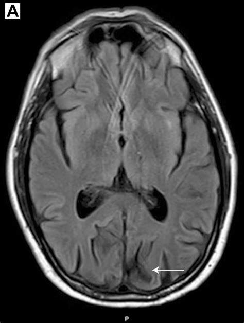 Posterior Cortical Atrophy
