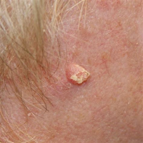 Early Squamous Cell Skin Cancer On Face