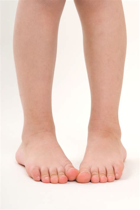 Does Your Child Have Pigeon Feet When Its Normal And When Its Not