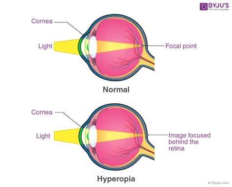 Eye Defects Types Examples And Definition Hypermetropia Treatment