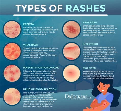 Skin Rash After Finishing Antibiotics