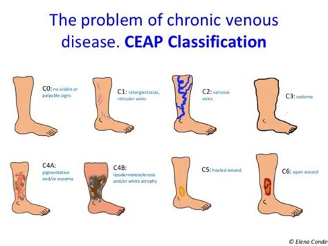 Ceap Classification Of Chronic Venous Disorders Lets All Speak The