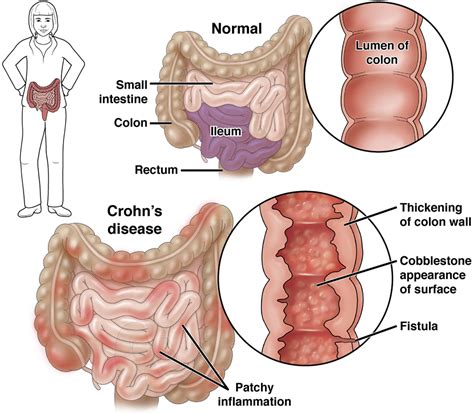 Crohn’s Disease Aga Gi Patient Center