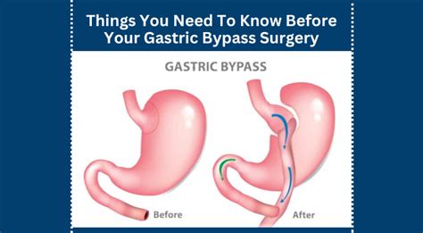 Things You Need To Know Before Your Gastric Bypass Surgery